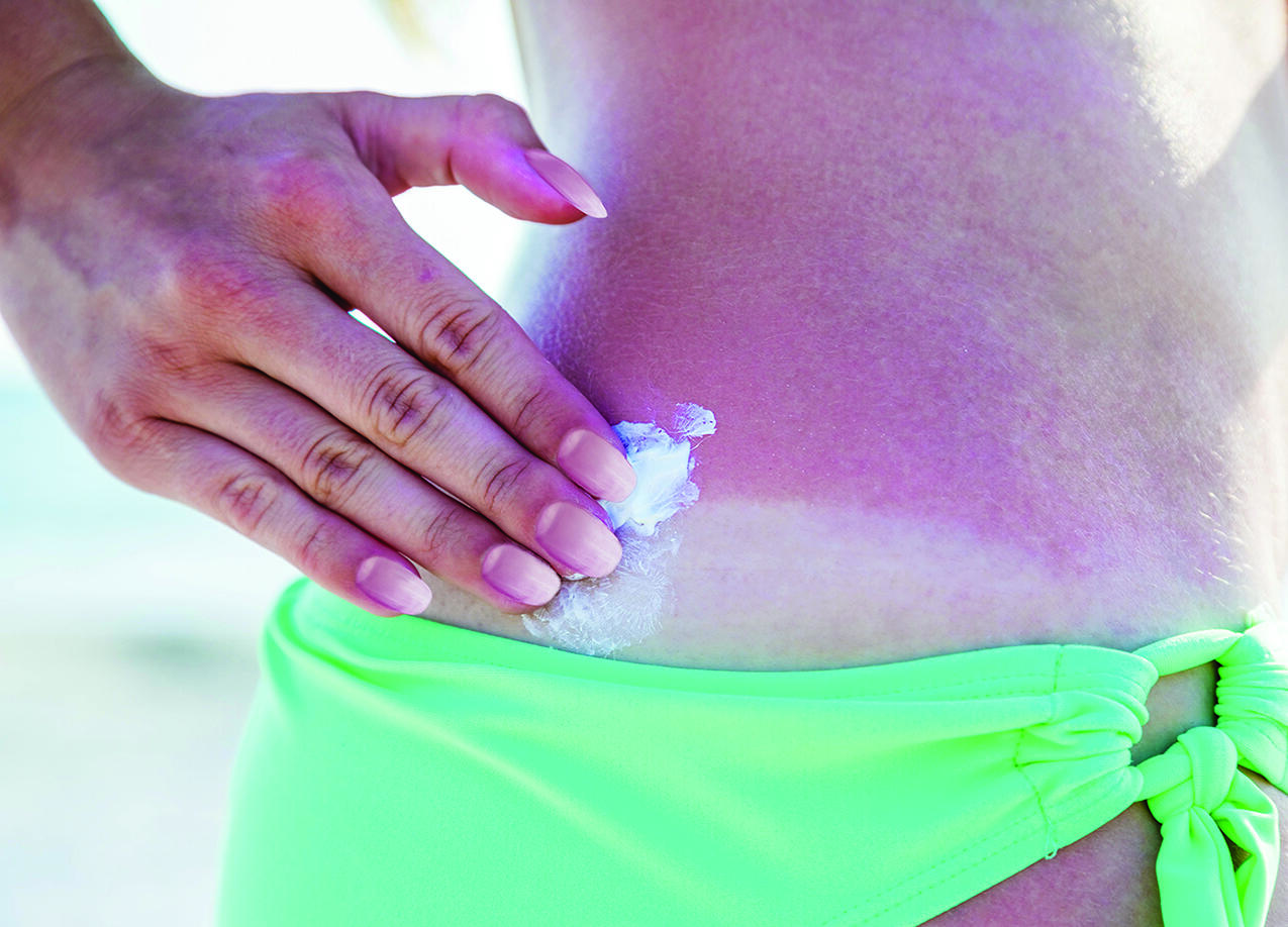 Sunburn is an inflammatory reaction to ultraviolet radiation damage to the skin’s outermost layers, says the Skin Cancer Foundation.